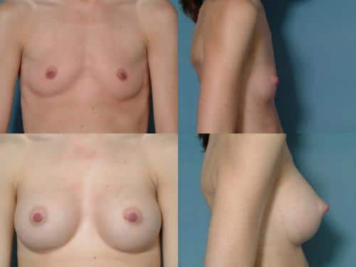 Breast Augmentation Case #114 Combined Image