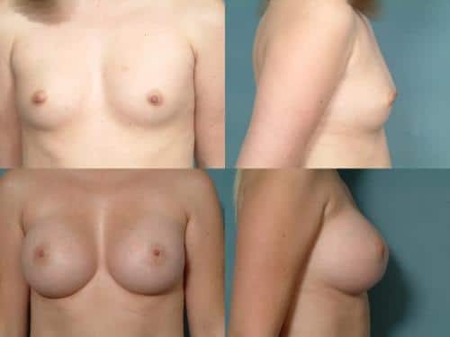 Breast Augmentation Case #115 Combined Image