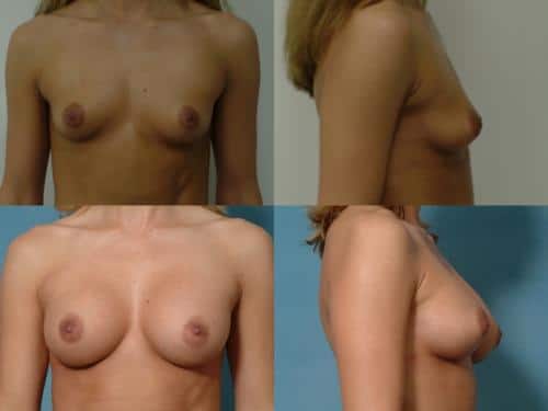 Breast Augmentation Case #116 Combined Image