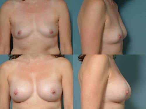 Breast Augmentation Case #118 Combined Image