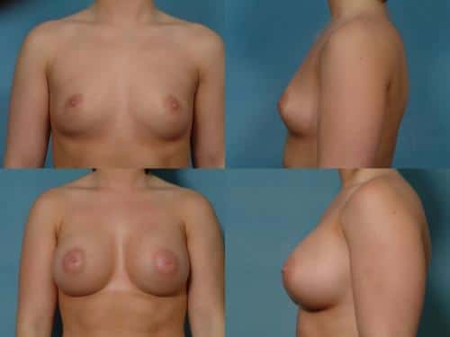 Breast Augmentation Case #121 Combined Image