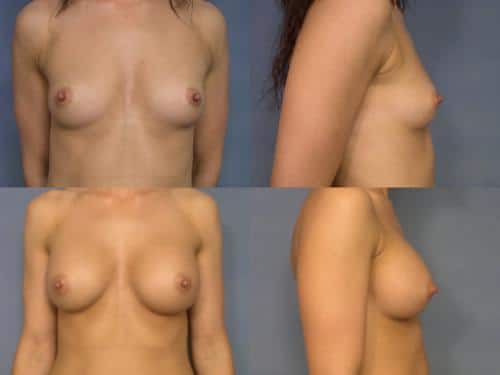 Breast Augmentation Case #173 Combined Image