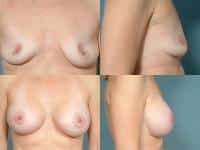 Breast Augmentation Case #174 Combined Image