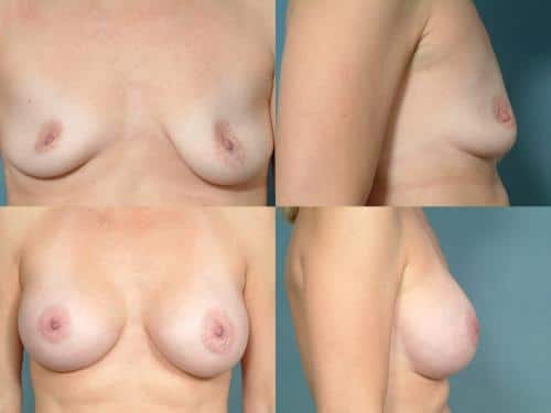 Breast Augmentation Case #174 Combined Image