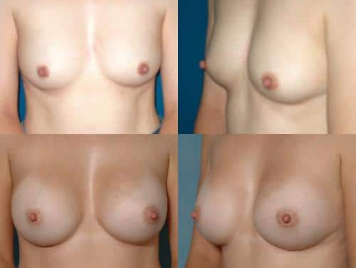 Breast Augmentation Case #175 Combined Image