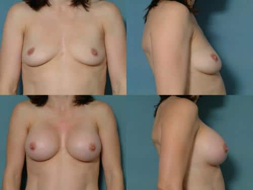 Breast Augmentation Case #176 Combined Image