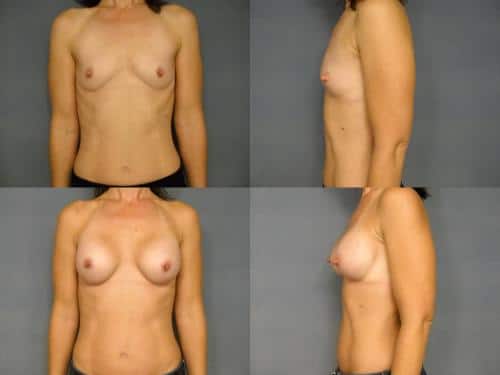 Breast Augmentation Case #196 Combined Image