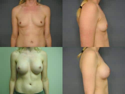 Breast Augmentation Case #197 Combined Image