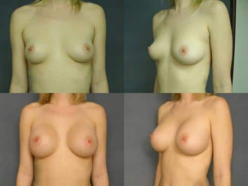 Breast Augmentation Case #198 Combined Image