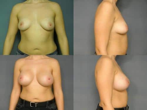 Breast Augmentation Case #199 Combined Image