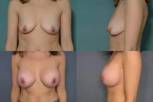 Breast Augmentation Case #206 Combined Image