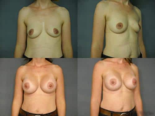 Breast Augmentation Case #207 Combined Image
