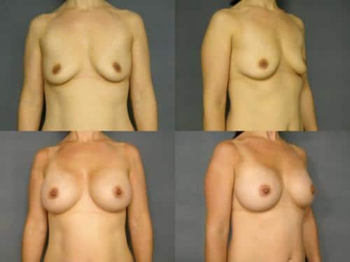 Breast Augmentation Case #219 Combined Image
