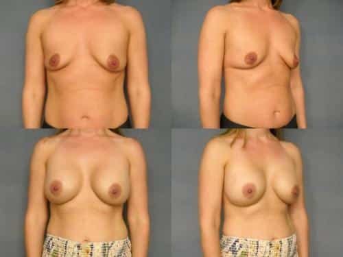 Breast Augmentation Case #223 Combined Image