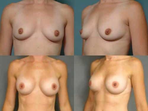 Breast Augmentation Case #224 Combined Image