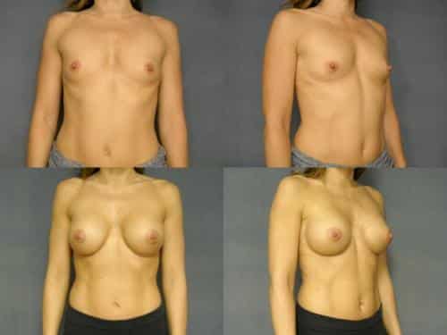 Breast Augmentation Case #225 Combined Image