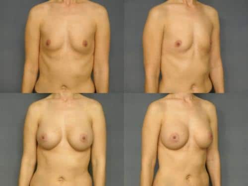 Breast Augmentation Case #238 Combined Image