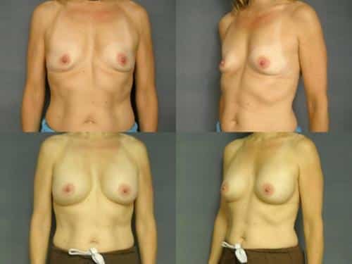Breast Augmentation Case #271 Combined Image