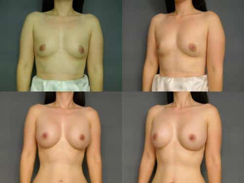 Breast Augmentation Case #275 Combined Image