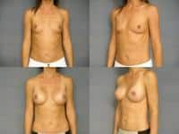 Breast Augmentation Case #298 Combined Image