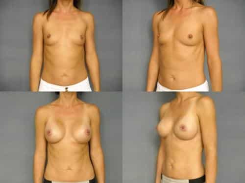 Breast Augmentation Case #298 Combined Image