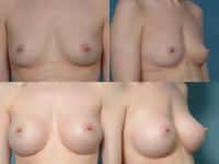 Breast Augmentation Case #299 Combined Image