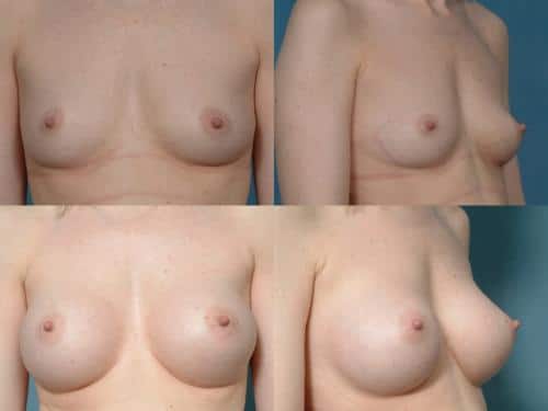 Breast Augmentation Case #299 Combined Image
