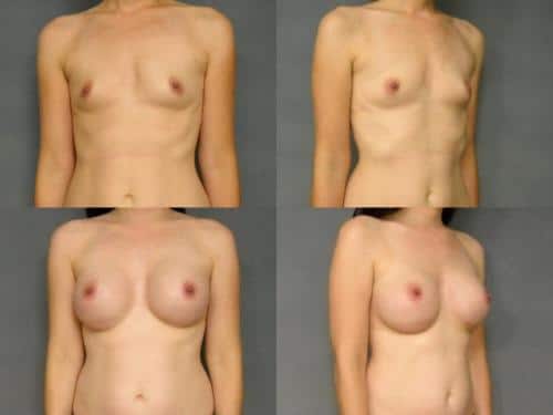 Breast Augmentation Case #305 Combined Image