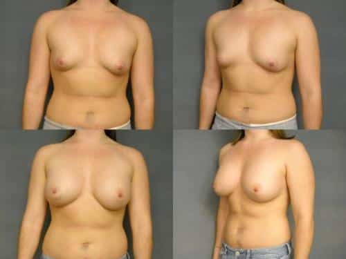 Breast Augmentation Case #309 Combined Image