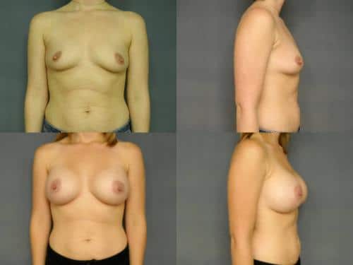 Breast Augmentation Case #310 Combined Image