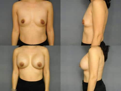 Breast Augmentation Case #311 Combined Image