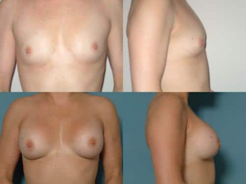 Breast Augmentation Case #321 Combined Image
