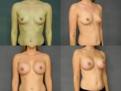 Breast Augmentation Case #411 Combined Image