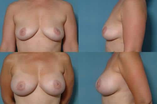 Breast Augmentation Case #461 Combined Image