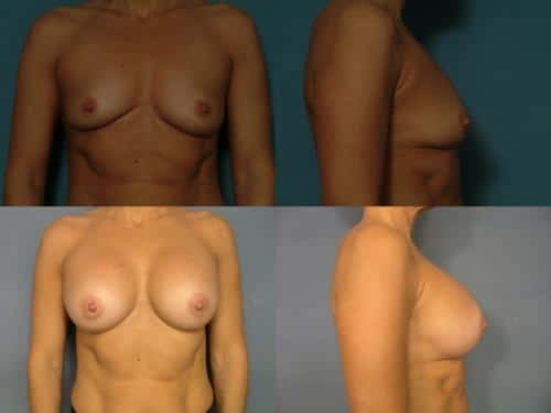 Breast Augmentation Case #491 Combined Image