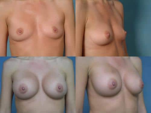 Breast Augmentation Case #501 Combined Image