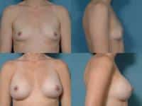 Breast Augmentation Case #511 Combined Image