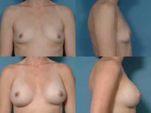 Breast Augmentation Case #511 Combined Image