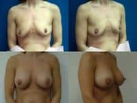 Breast Augmentation Case #571 Combined Image
