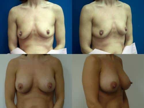 Breast Augmentation Case #571 Combined Image
