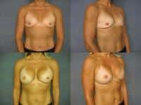 Breast Augmentation Case #611 Combined Image
