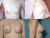 Breast Augmentation Case #621 Combined Image