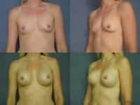 Breast Augmentation Case #661 Combined Image