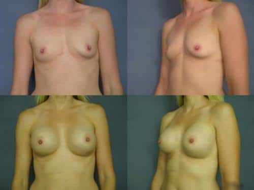 Breast Augmentation Case #661 Combined Image