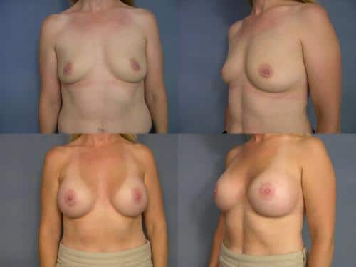 Breast Augmentation Case #701 Combined Image