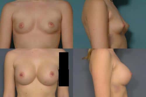 Breast Augmentation Case #731 Combined Image