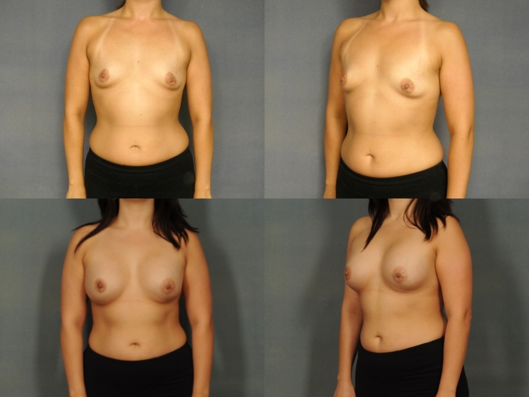 Breast Augmentation Case# 773 Combined Image
