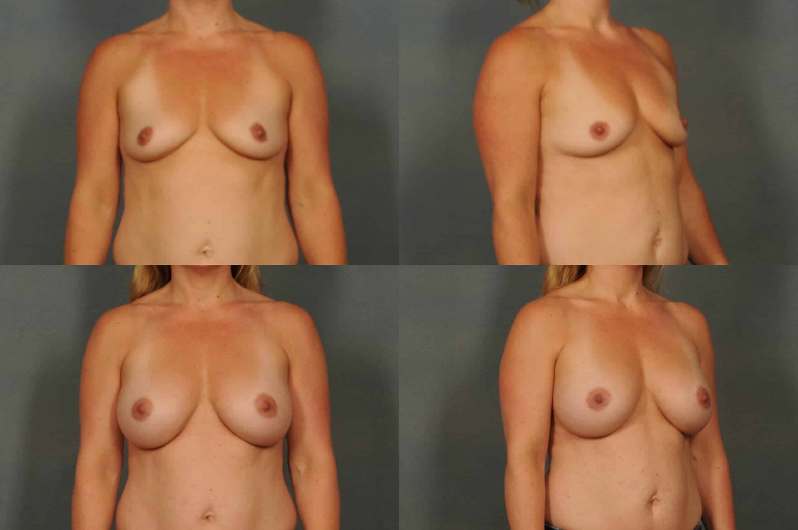 Breast Augmentation Case# 796 Combined Image