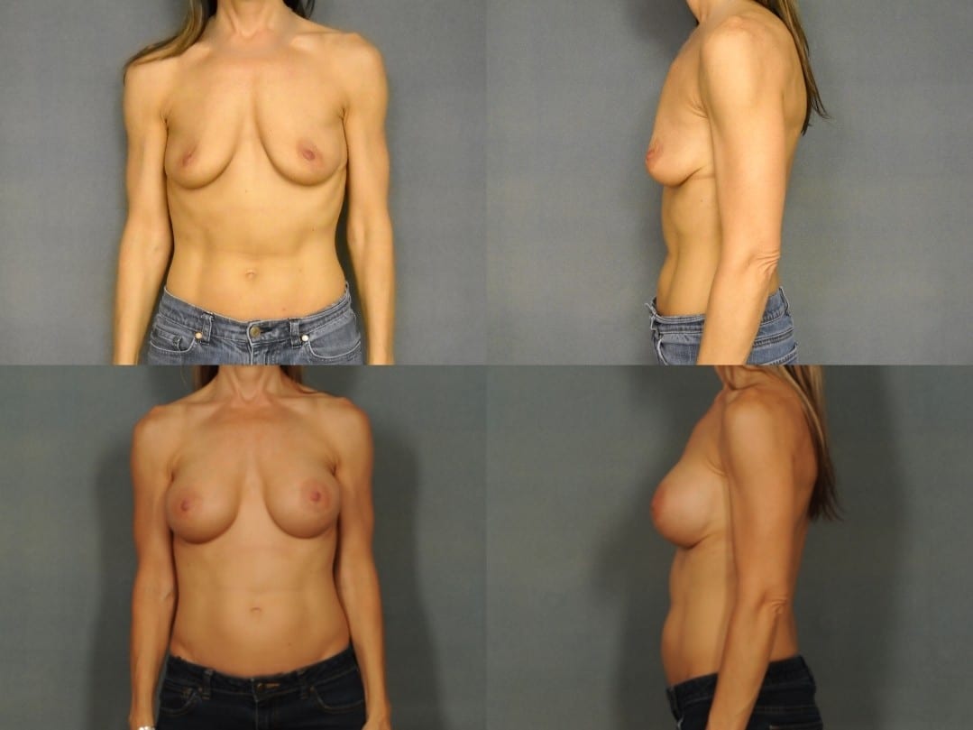 Breast Augmentation Case# 810 Combined Image