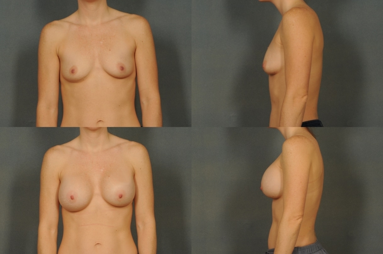 Breast Augmentation Case# 816 Combined Image